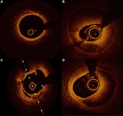 Optical Coherence Tomography and Coronary Dissection: Precious Tool or Useless Surplus?